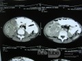 Intussusception , non Hodgkin's lymphoma CT