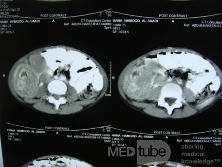 Intussusception , non Hodgkin's lymphoma CT