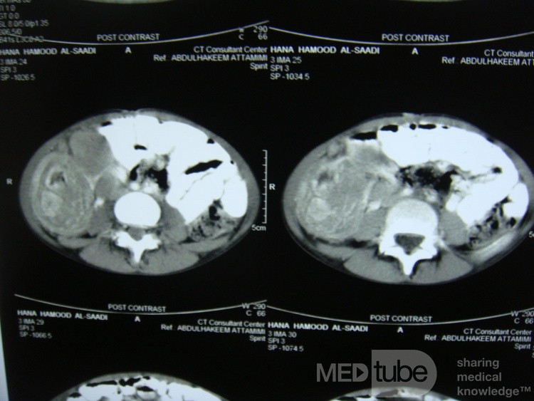 Intussusception , non Hodgkin's lymphoma CT