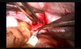 Removal of a Very Unusual IVC tumor via the Right Atrium