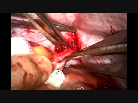 Removal of a Very Unusual IVC tumor via the Right Atrium