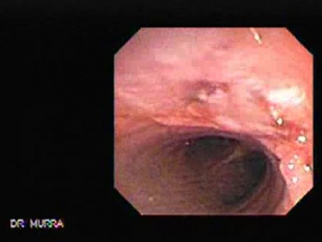 Tracheal Endoscopy - main carina 3/5