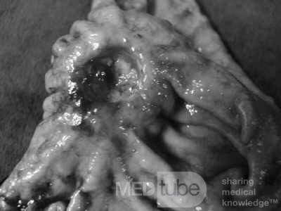 Diffuse Adenocarcinoma with signet ring cells (10 of 18)