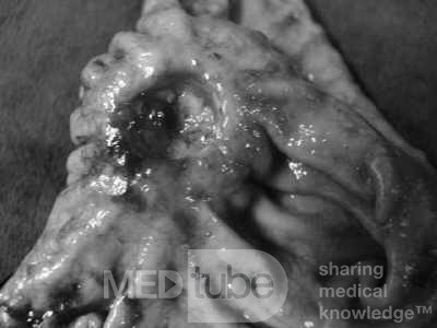 Diffuse Adenocarcinoma with signet ring cells (10 of 18)