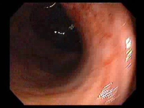 Bleeding Due to Dieulafoy´s Lesion (4 of 8)