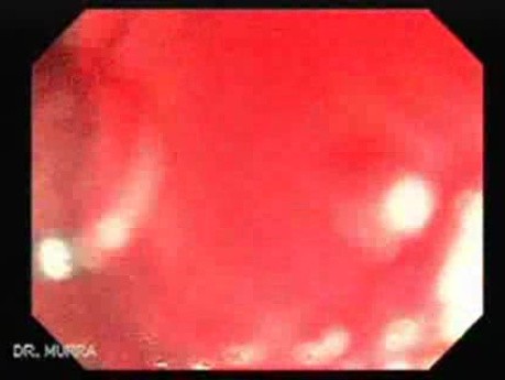 Huge Mass Of The Descending Colon (2 of 25)