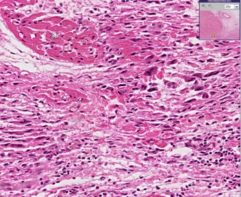Heart Infammated by Rheumatic Fever