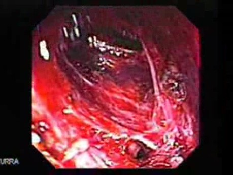 Adenocarcinoma of the Gastroesophageal Junction - a Small Fistula Tract