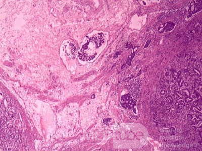Adenocarcinoma of the Antrum and incisura angularis (12 of 12)