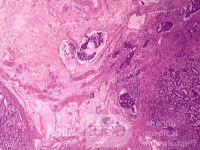 Adenocarcinoma of the Antrum and incisura angularis (12 of 12)