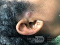 Preauricular Pit and Infected Preauricular Sinus