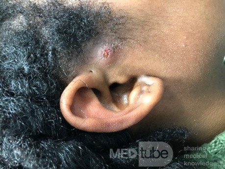 Preauricular Pit and Infected Preauricular Sinus