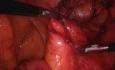 Laparoscopic Reversal of Hartmann's Colostomy