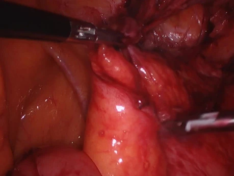 Laparoscopic Reversal of Hartmann's Colostomy