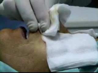 Rhinoplasty - Long nose