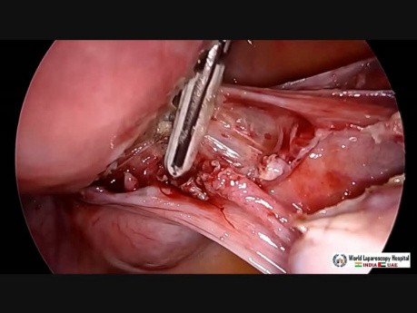 Laparoscopic Hysterectomy And Appendectomy Using Illuminated Ureteral Stent Step Step Demonstration