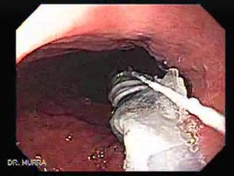 Intragastric Balloon - The Treatment Of Obesity (3 of 13)