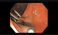 Colonoscopy Channel - How To Perform EMR - Lesion F