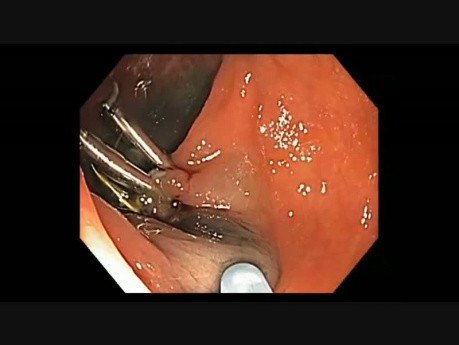 Colonoscopy Channel - How To Perform EMR - Lesion F
