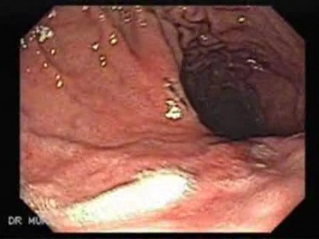 Hourglass Stomach - Stenosis of Stomach