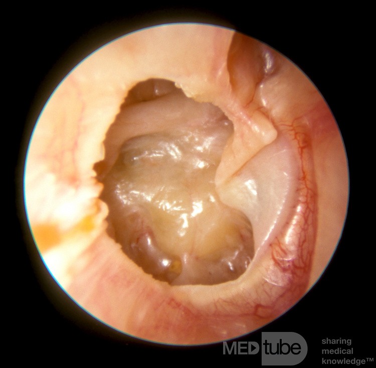 Severe Atelectasis