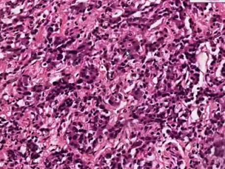 Primary chronic adrenal insuff - Adrenal gland - Histopathology