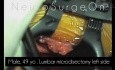 Simple Lumbal Microdiscectomy