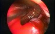 Hanging Polyp Of The Maxillary Sinus - Endoscopic Removal