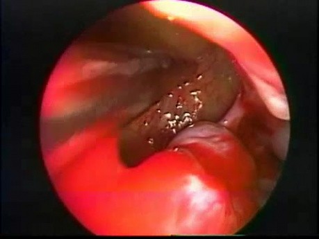 Hanging Polyp Of The Maxillary Sinus - Endoscopic Removal