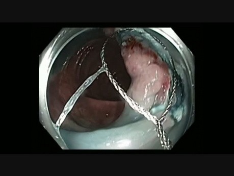 Colonoscopy Channel - EMR of a Large Hemicircumferential Lesion