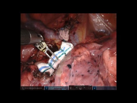 Unedited Robotic S1 Right Upper Lobe Segmentectomy