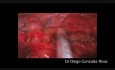 Bronchogenic Cyst Located on Paratracheal Space Resected by Single Incision VATS