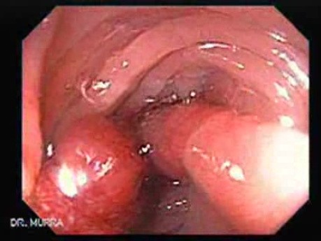 Pedicled Polyp (2 of 7)