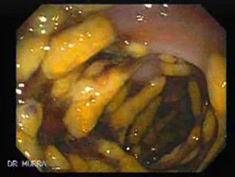 Pseudomembranous Colitis (4 of 11)