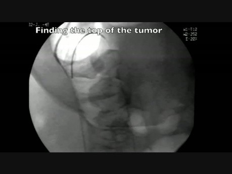 Colonoscopy Channel - Management Of Colon Obstruction - Stent Insertion