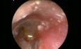 Use of T-Tube Introducer for An Atelectatic Eardrum-Tympanostomy Tube Insertion