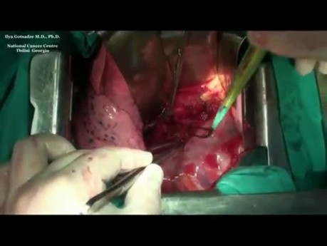 Transthoracic Subtotal Esophagectomy (Lewis Type Procedure)