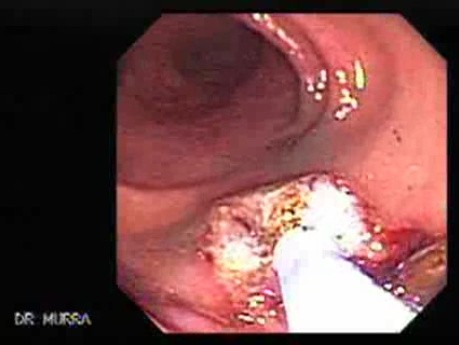 Cap Polyposis (6 of 7)
