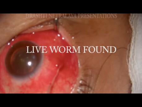 Living Worm in Sub Conjunctival Space