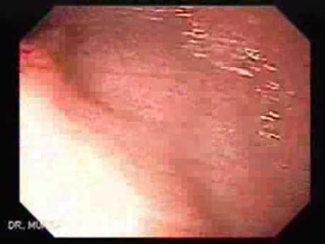 Colonic Interposition for Esophageal Substitution (8 of 11)