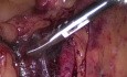 Laparoscopy as the most accurate diagnostic method in acute surgical cases and disseminated intraperitoneal malignancies