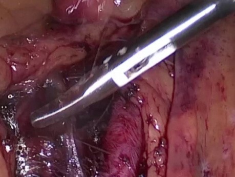 Laparoscopy as the most accurate diagnostic method in acute surgical cases and disseminated intraperitoneal malignancies