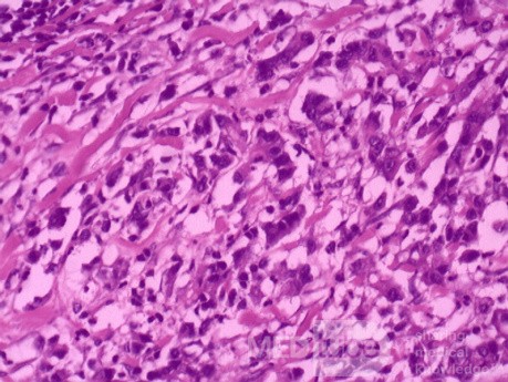 Diffuse Adenocarcinoma with signet ring cells (18 of 18)