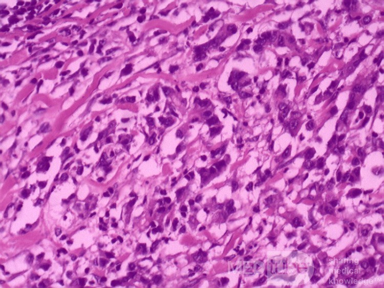 Diffuse Adenocarcinoma with signet ring cells (18 of 18)