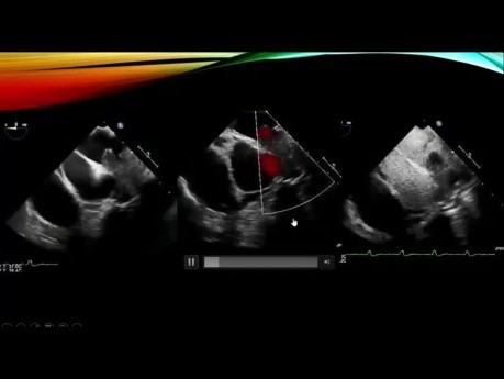 Echocardiography Assessment of Cardiac Masses & Neoplasms