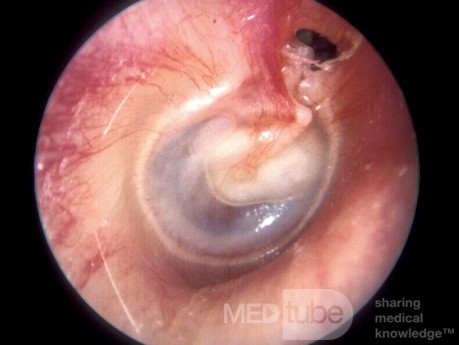 Attic Cholesteatoma