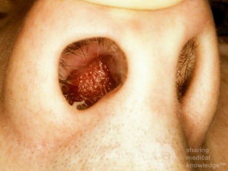 Nasal Septal Hematoma