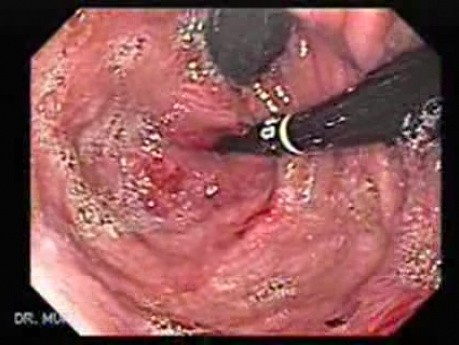 Adenocarcinoma of the Gastroesophageal Junction - Two Endoscopes in Retroflexed View