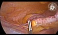 Lap Appendectomy