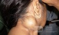 Large Lipoma Of The Neck